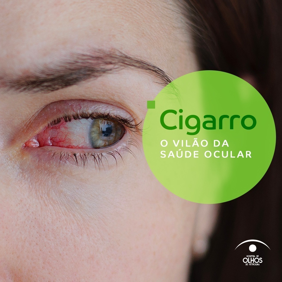 Cigarro – O vilão da saúde ocular