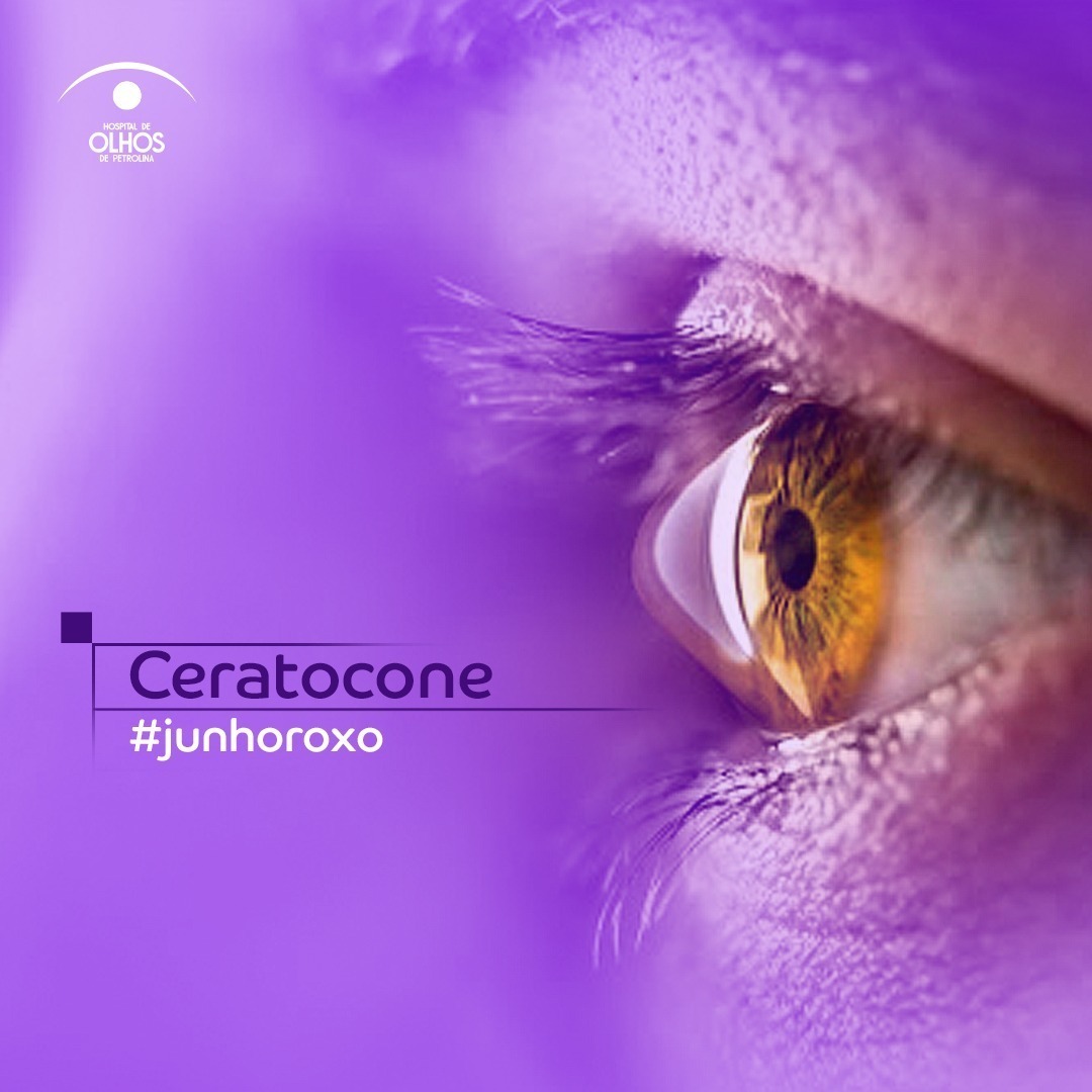 Ceratocone