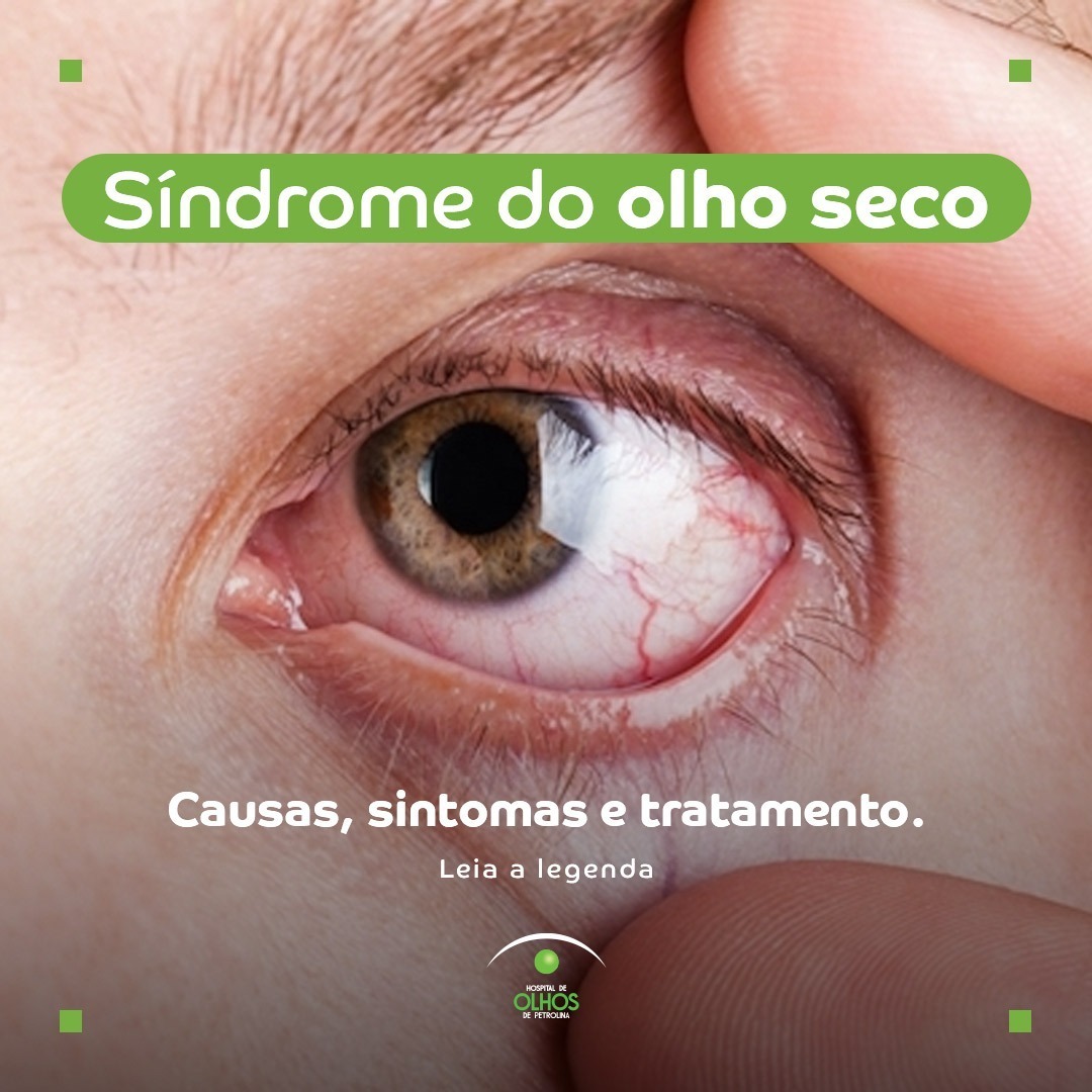 Síndrome do Olho Seco