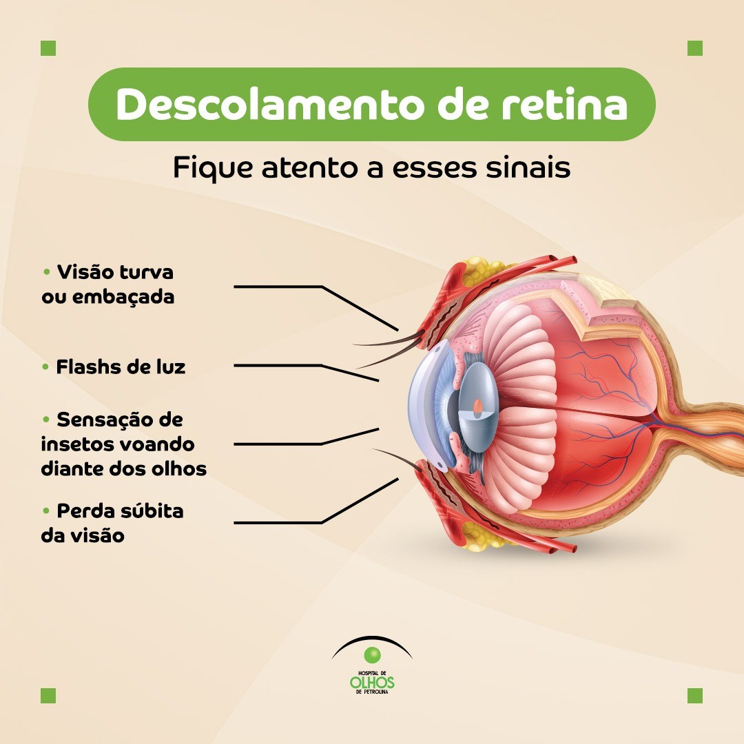 Descolamento de Retina