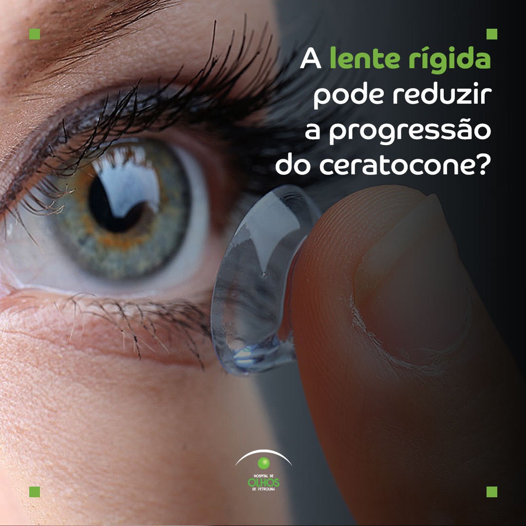 A lente rígida pode reduzir a progressão do ceratocone?