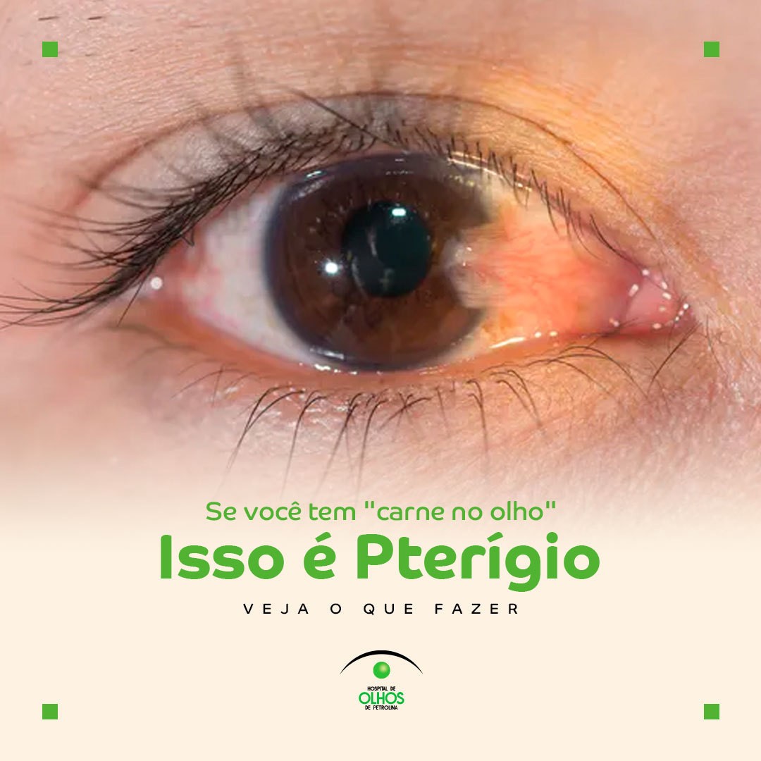 O que é Pterígio