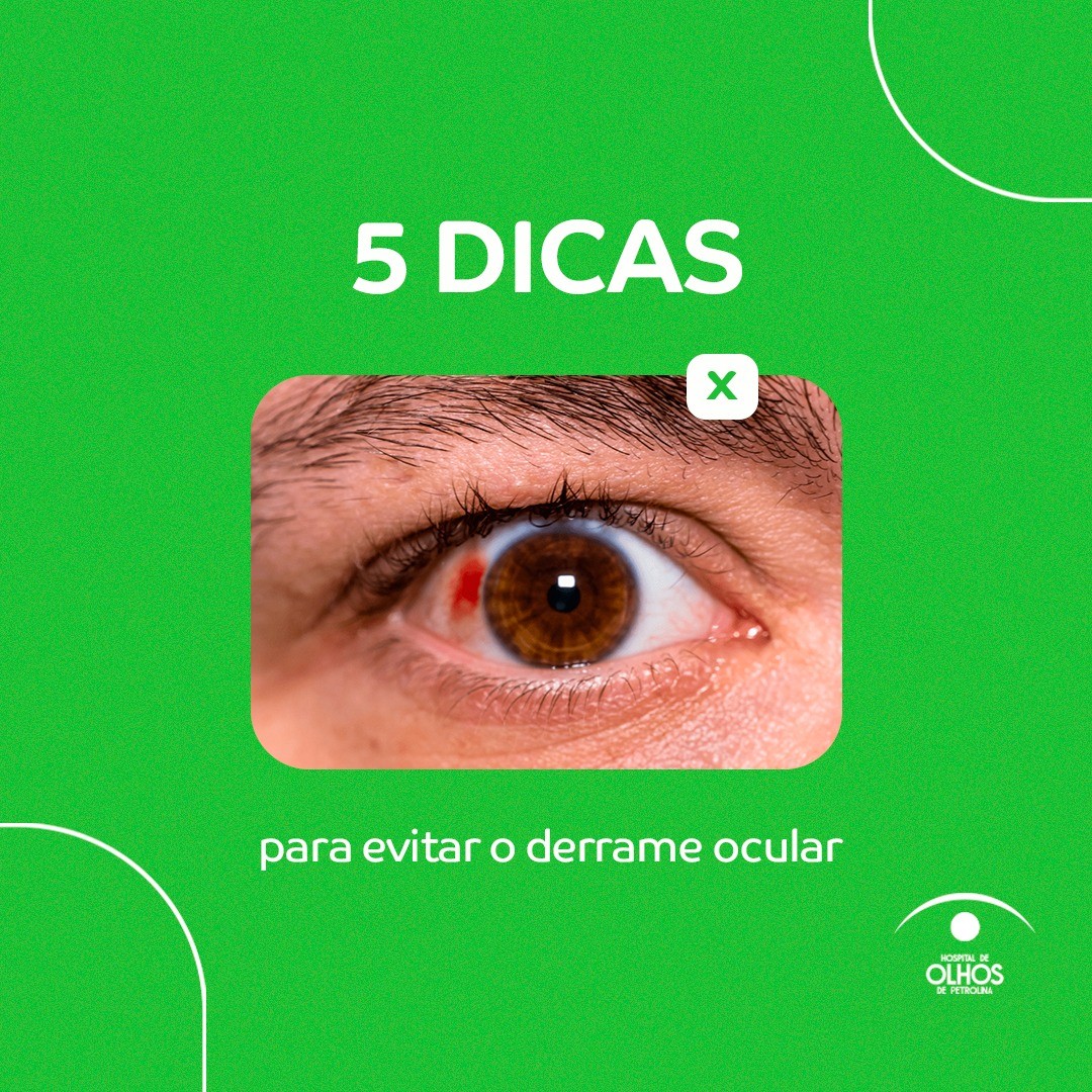 5 dicas para evitar o derrame ocular