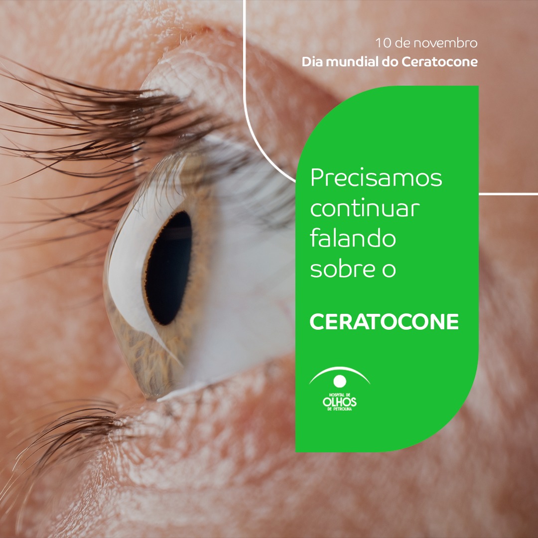 Ceratocone
