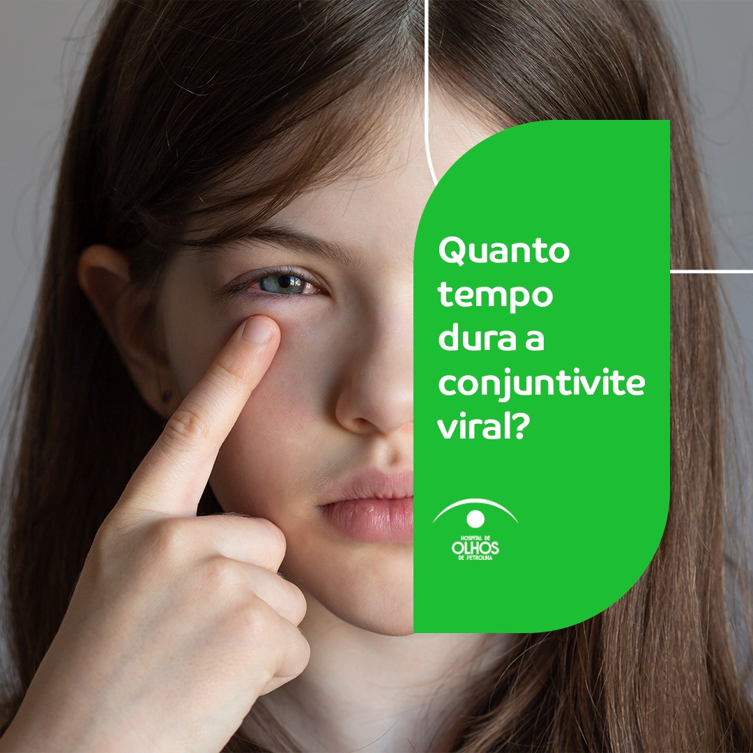 Quanto tempo dura a conjuntivite viral?